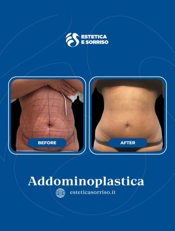 Addominoplastica - Estetica e Sorriso