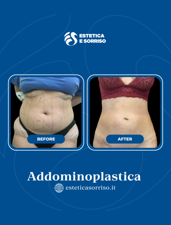 Addominoplastica - Estetica e Sorriso