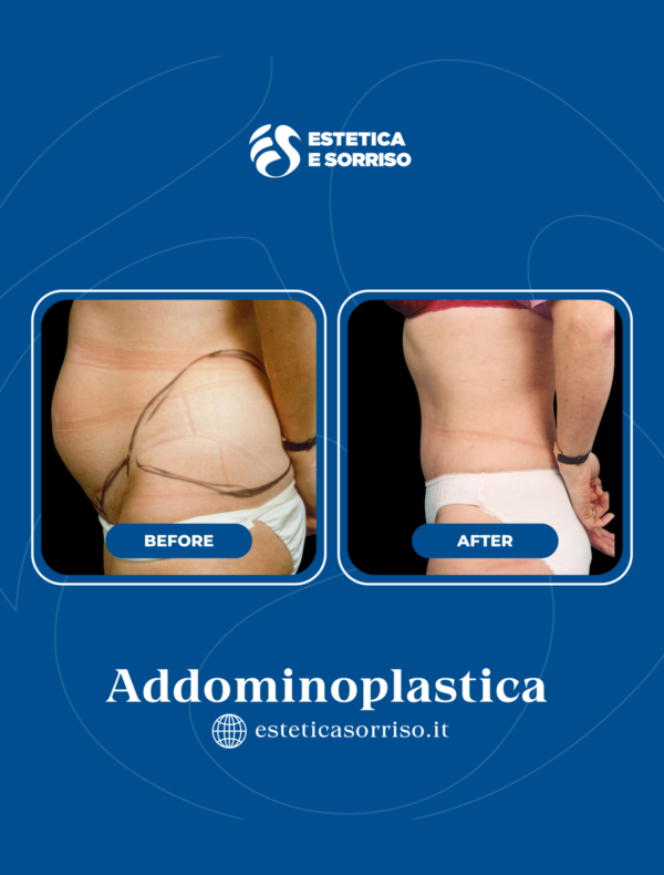 Addominoplastica - Estetica e Sorriso