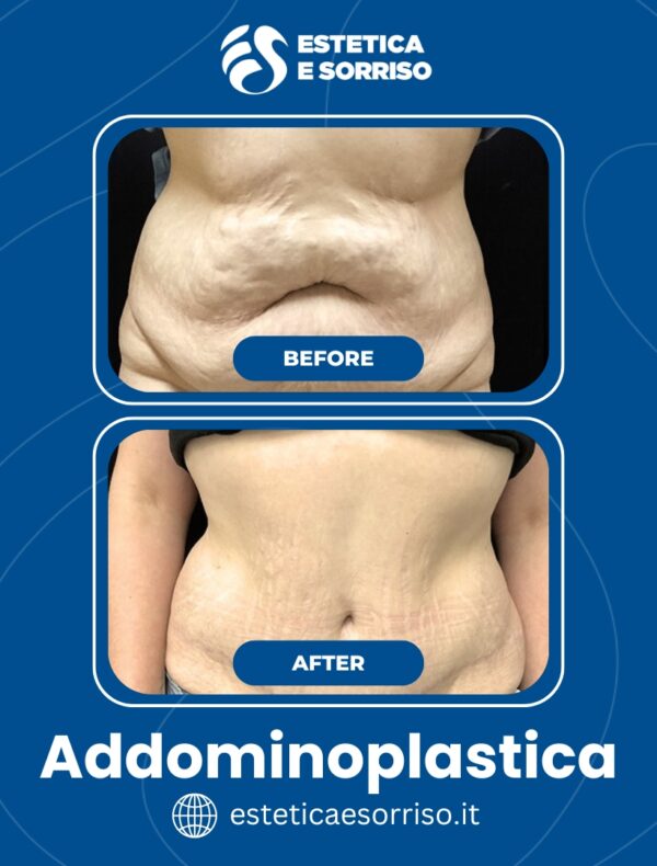 Addominoplastica - Estetica e Sorriso