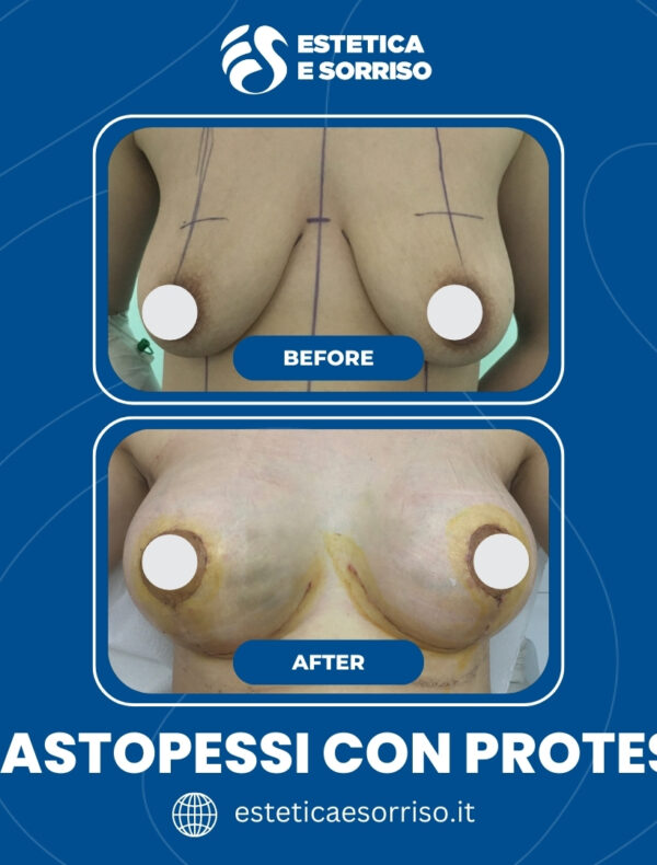Mastopessi con Protesi - Estetica e Sorriso