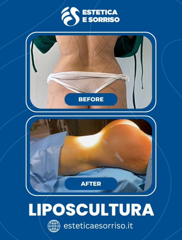 Liposcultura - Estetica e Sorriso