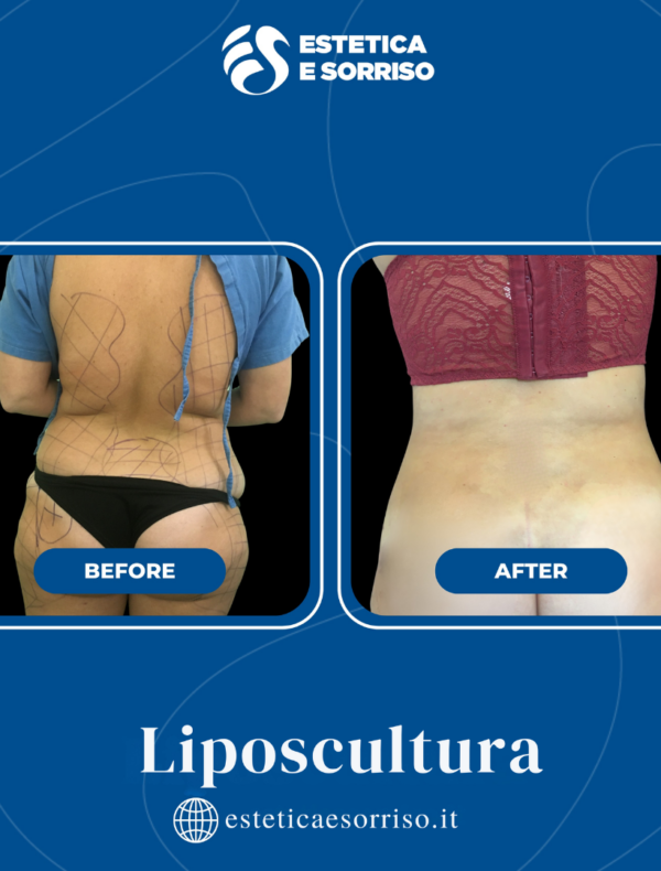 Liposcultura - Estetica e Sorriso